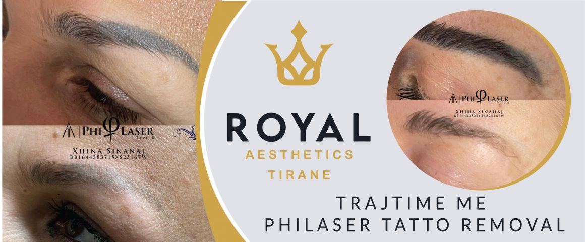 Trajtime me Philaser tatto removal (heqja e tatuazheve te vetullave & trupit)